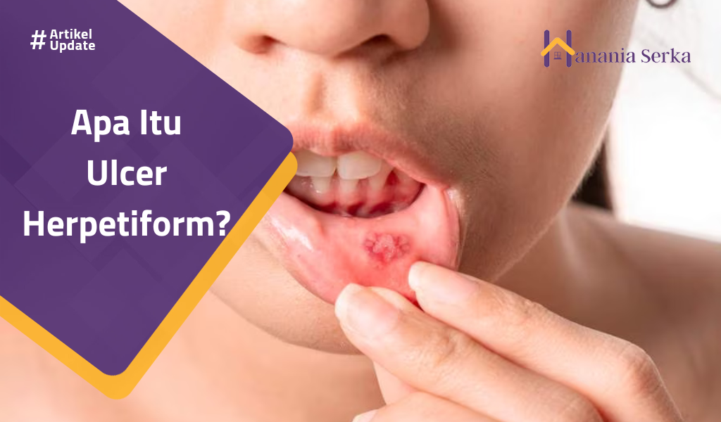 You are currently viewing Apa Itu Ulcer Herpetiform?