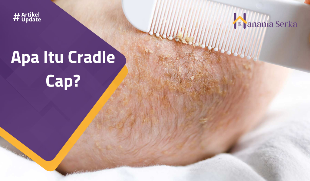 You are currently viewing Apa Itu Cradle Cap?