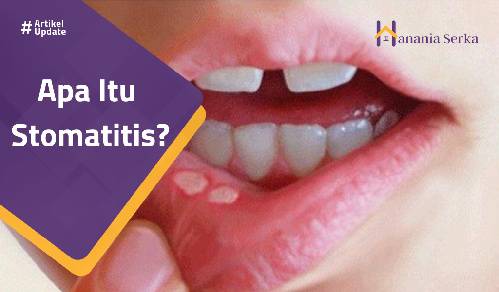 You are currently viewing Apa Itu Stomatitis?