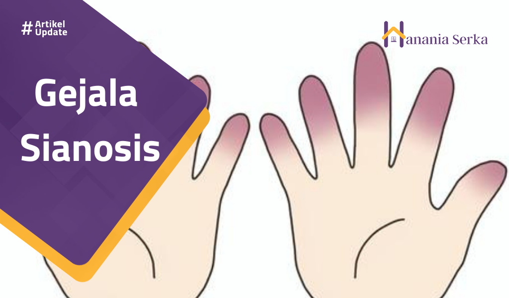 You are currently viewing Gejala Sianosis