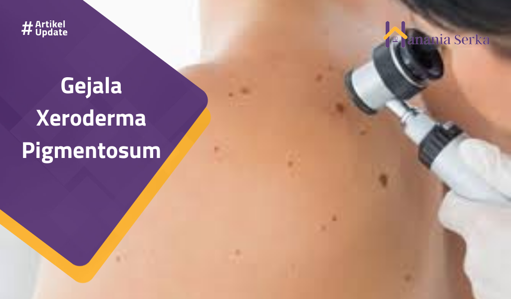 Read more about the article Gejala Xeroderma Pigmentosum