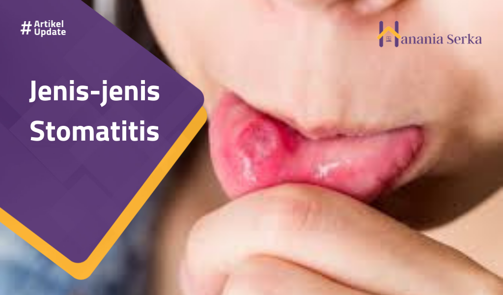 Read more about the article Jenis-jenis Stomatitis