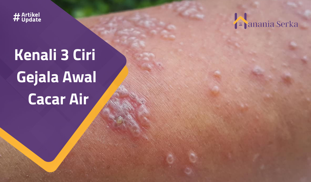 You are currently viewing Kenali 3 Ciri Gejala Awal Cacar Air