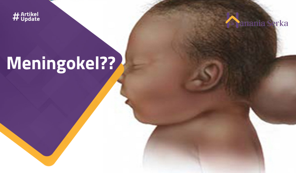 You are currently viewing Meningokel??