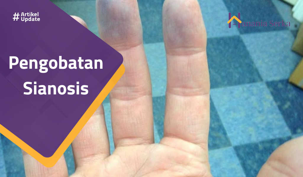 Read more about the article Pengobatan Sianosis