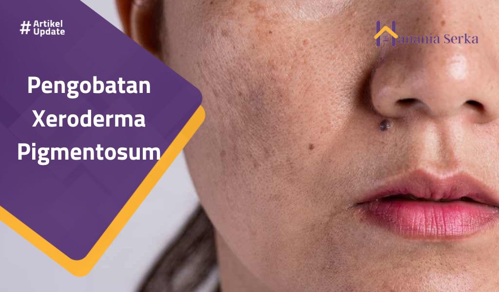 Read more about the article Pengobatan Xeroderma Pigmentosum
