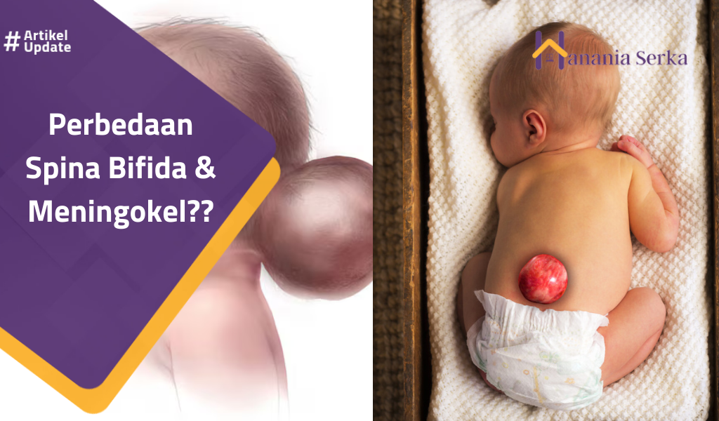 Read more about the article Perbedaan Spina Bifida & Meningokel?