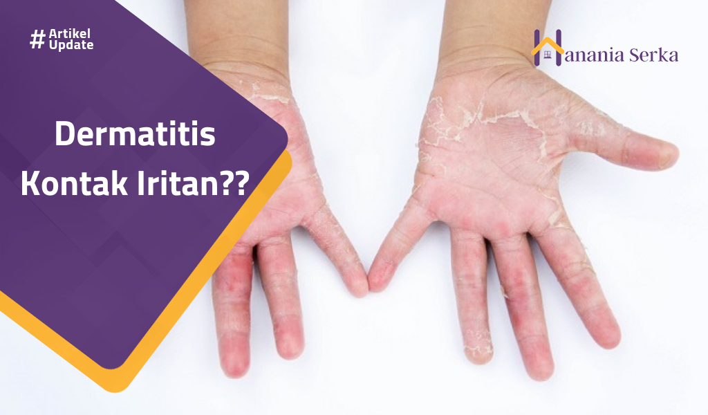 You are currently viewing Dermatitis Kontak Iritan??