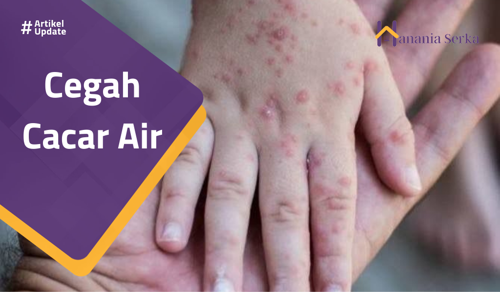 Read more about the article Cegah Cacar Air