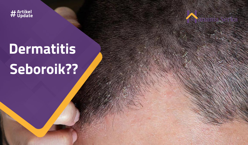 You are currently viewing Dermatitis Seboroik??