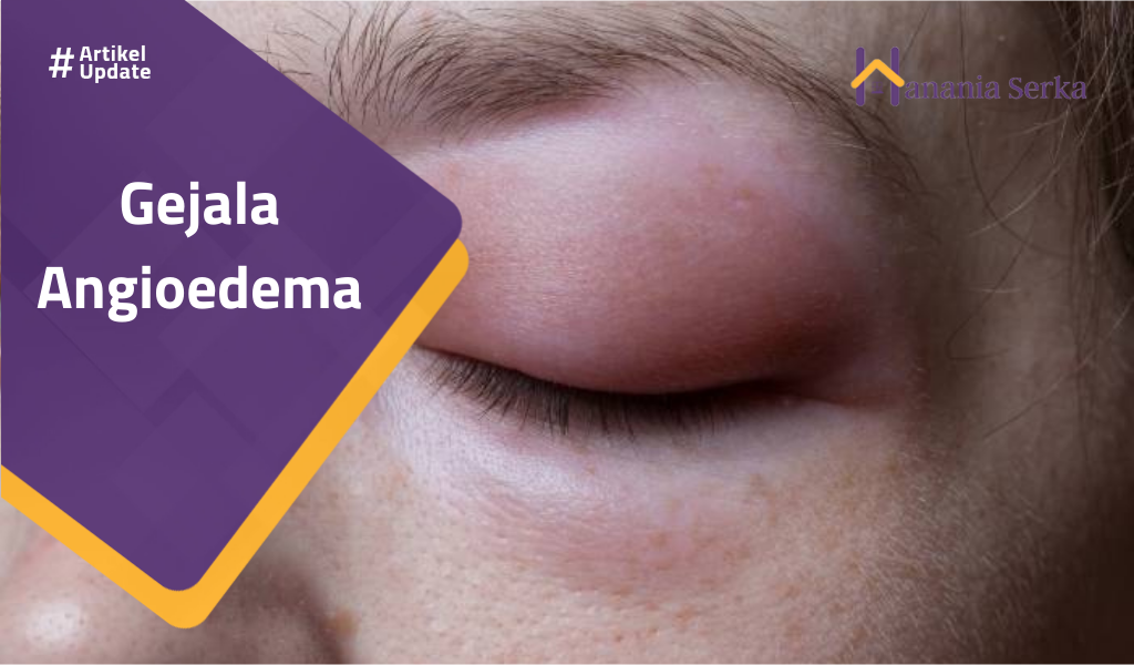Read more about the article Gejala Angioedema