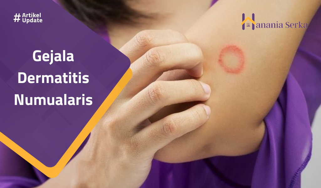 You are currently viewing Gejala Dermatitis Numualaris