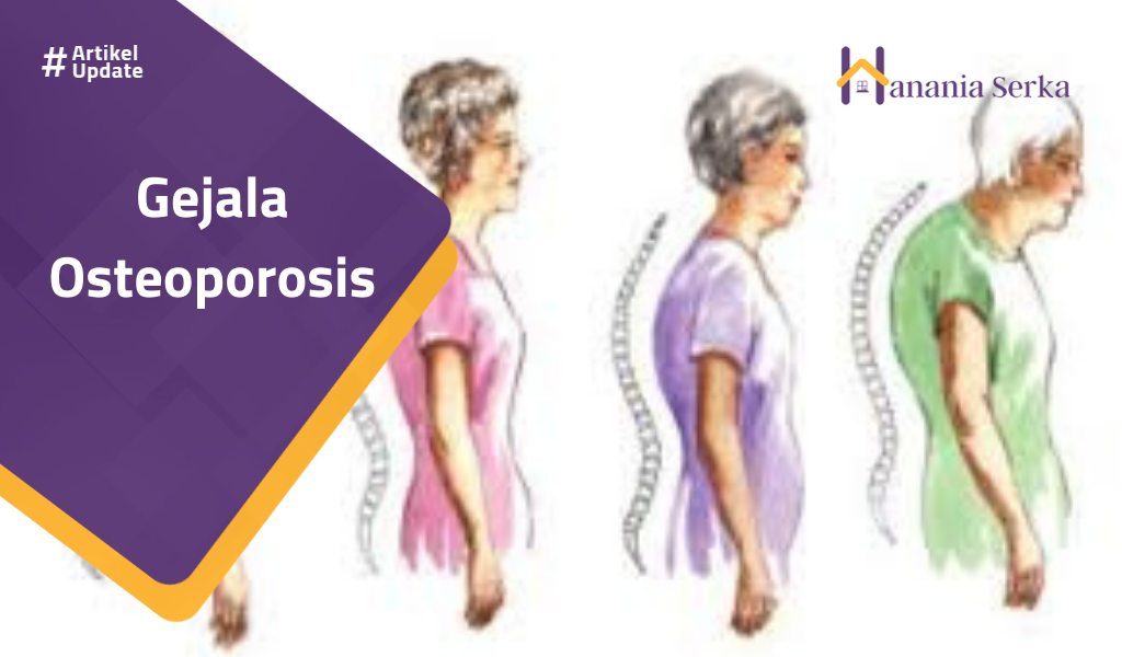 You are currently viewing Gejala Osteoporosis