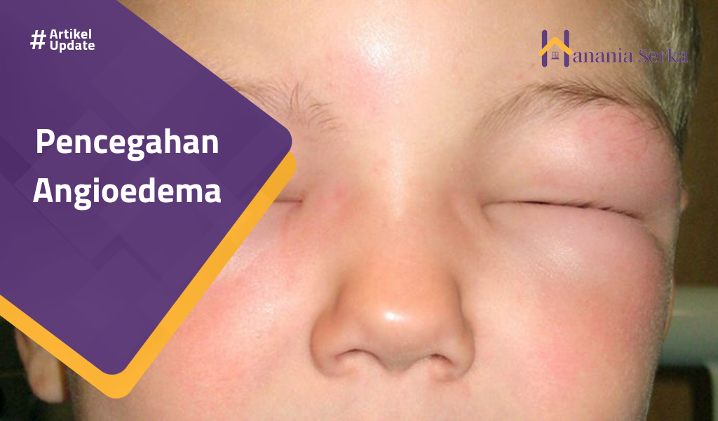 You are currently viewing Pencegahan Angioedema