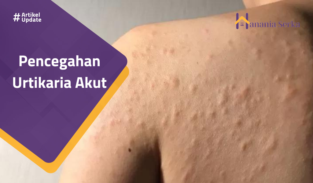 Read more about the article Pencegahan Urtikaria Akut