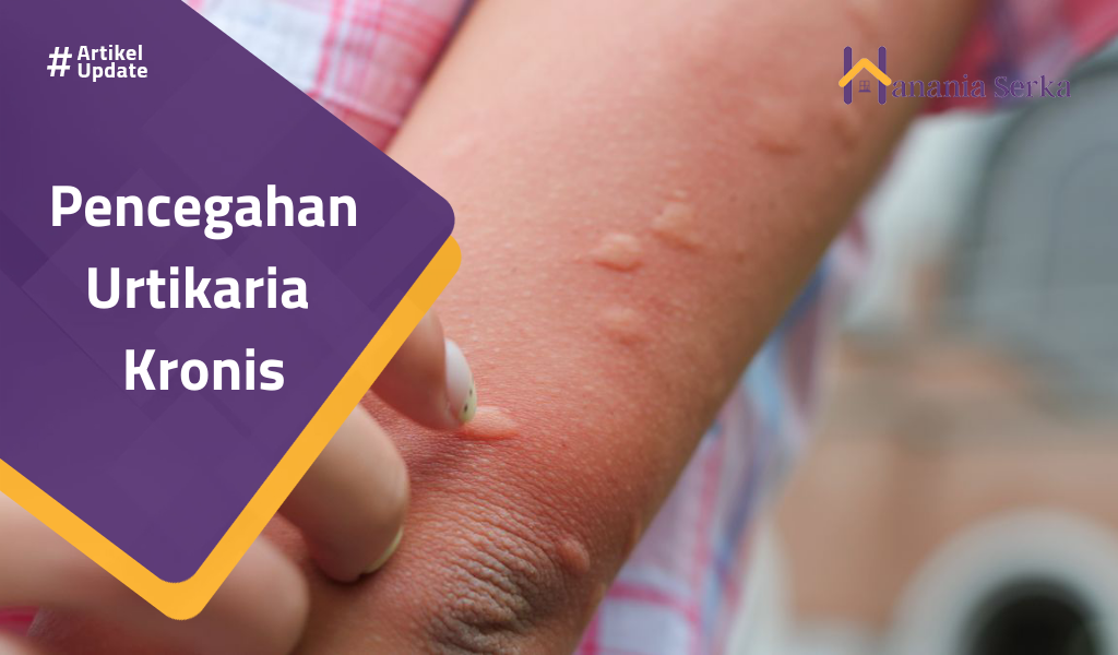 You are currently viewing Pencegahan Urtikaria Kronis