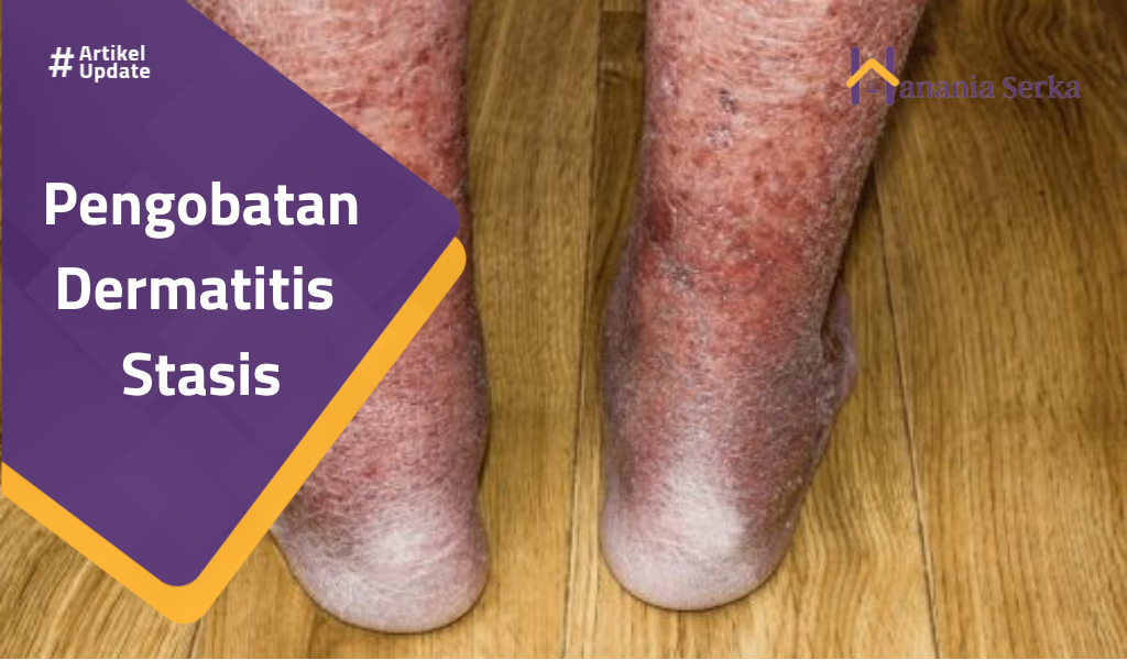 You are currently viewing Pengobatan Dermatitis Stasis
