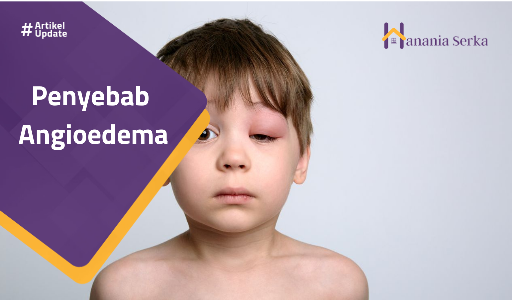 You are currently viewing Penyebab Angioedema