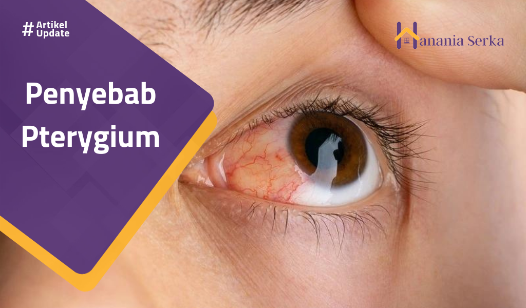 You are currently viewing Penyebab Gterygium