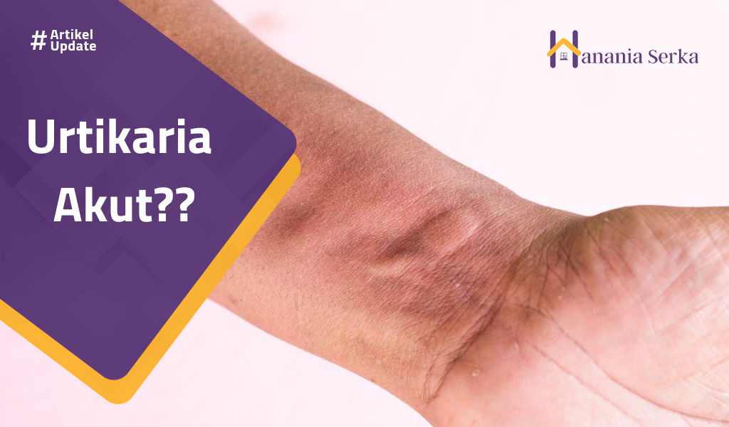 You are currently viewing Urtikaria Akut??