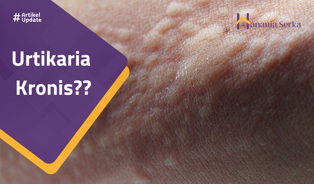 You are currently viewing Urtikaria Kronis??