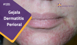 Read more about the article Gejala Dermatitis  Perioral