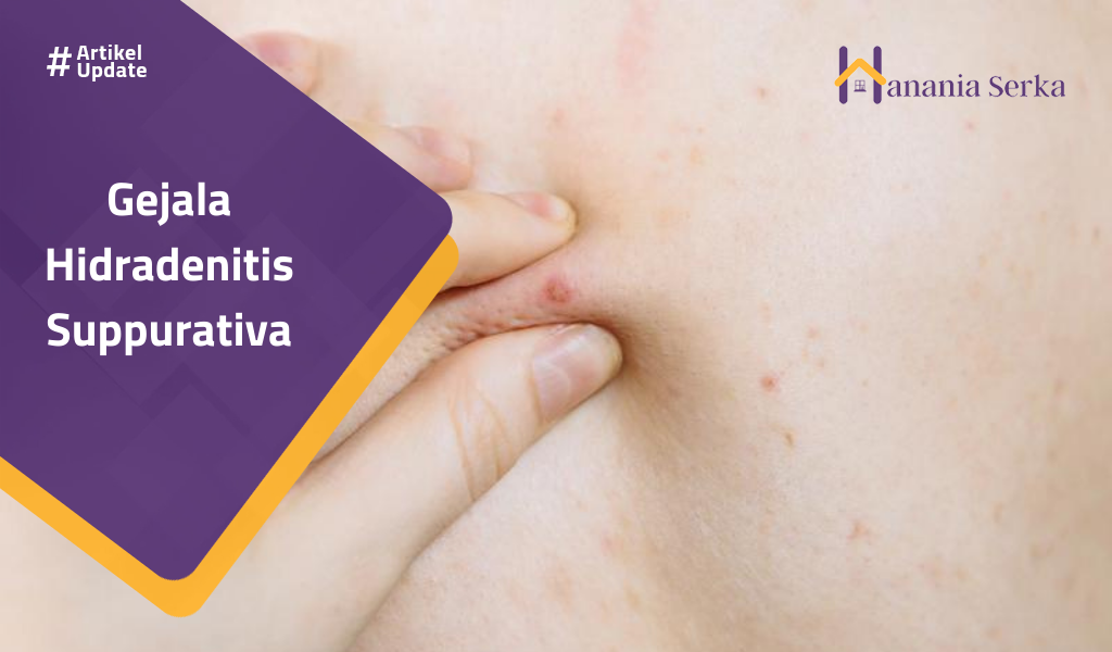 You are currently viewing Gejala Hidradenitis Suppurativa