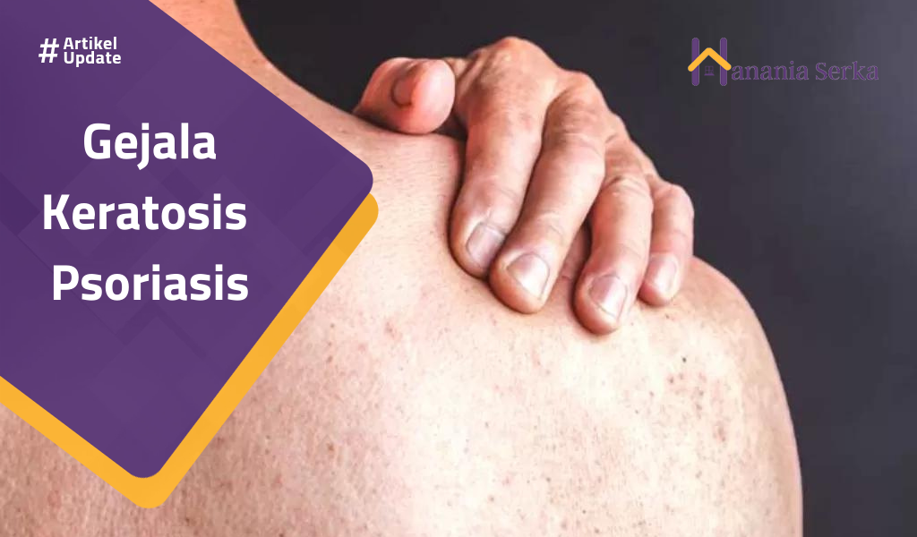 You are currently viewing Gejala Keratosis Psoriasis