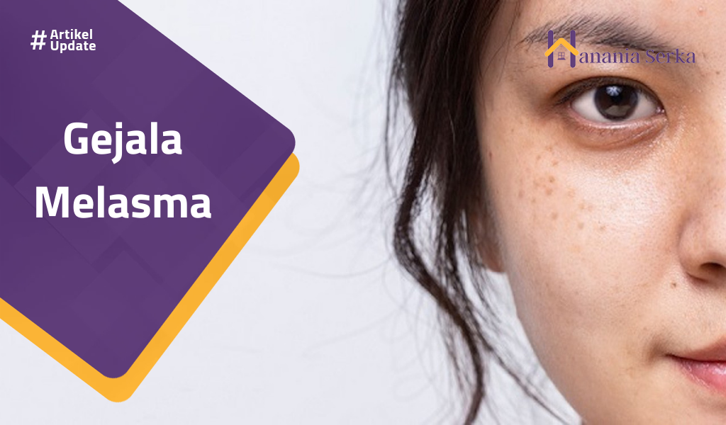 Read more about the article Gejala Melasma