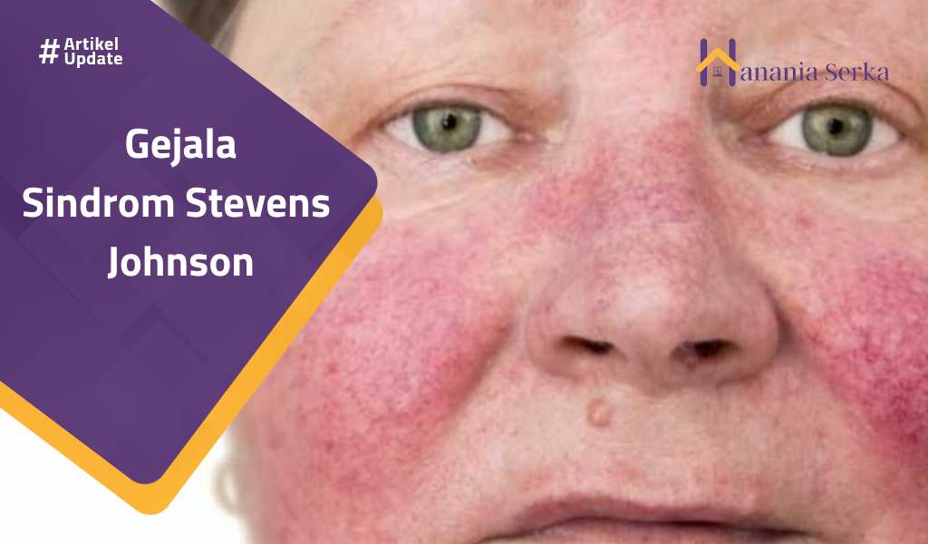 Read more about the article Gejala Sindrom Steven Johnson