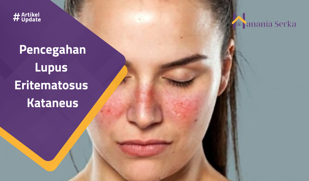 Read more about the article Pencegahan Lupus  Eritematosus  Kataneus