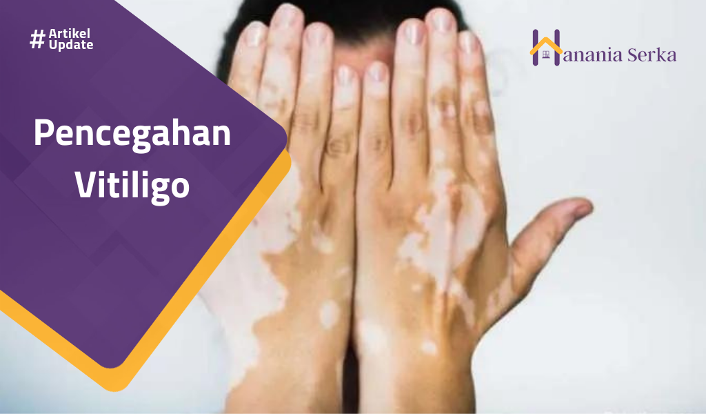 You are currently viewing Pencegahan Vitiligo