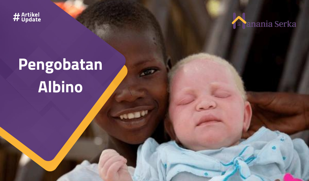 You are currently viewing Pengobatan Albino