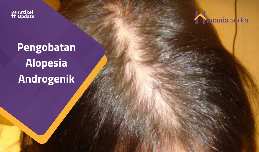Read more about the article Pengobatan Alopesia Androgenik
