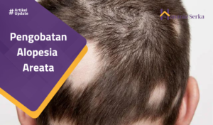 Read more about the article Pengobatan Alopesia Areata