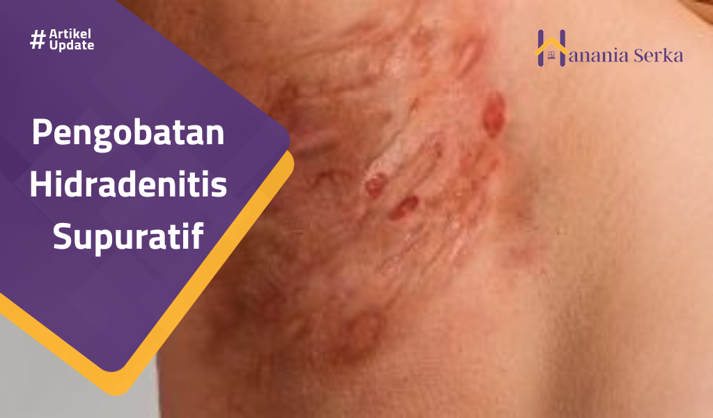 You are currently viewing Pengobatan Hidradenitis Supuratif