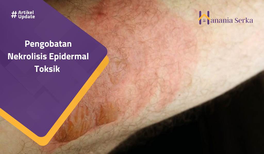 You are currently viewing Pengobatan Nekrolisis Epidermal Toksik