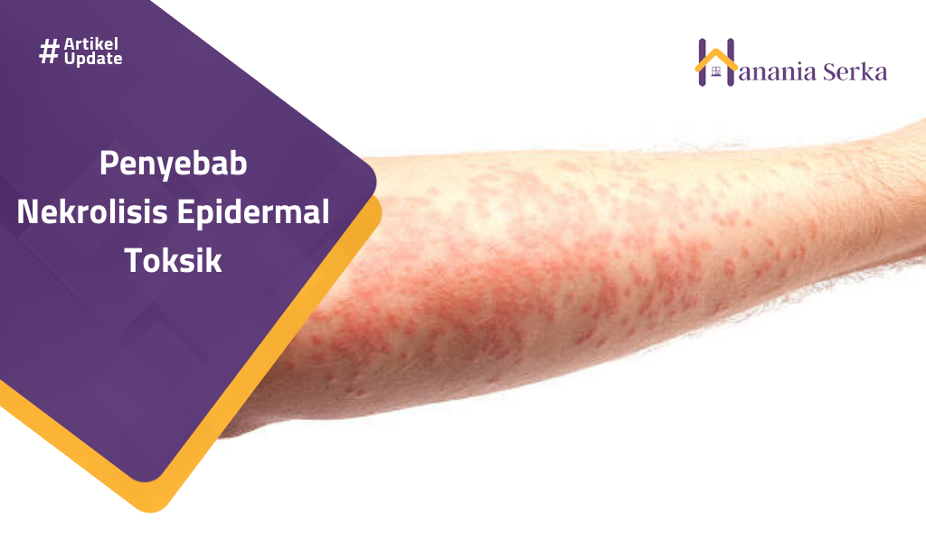 Read more about the article Penyebab Nekrolisis Epidermal Toksik