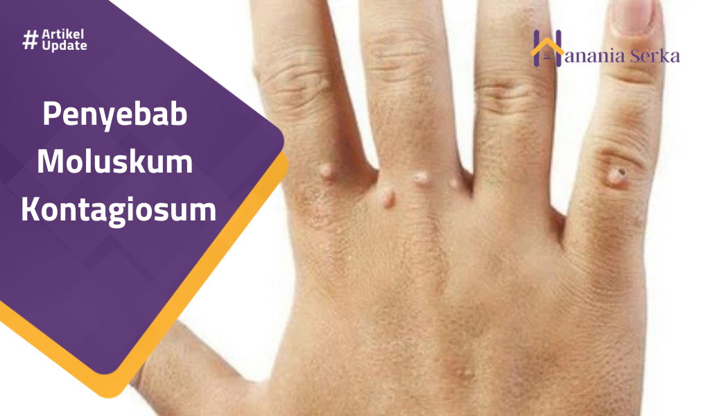 You are currently viewing Penyebab Moluskum Kontagiosum