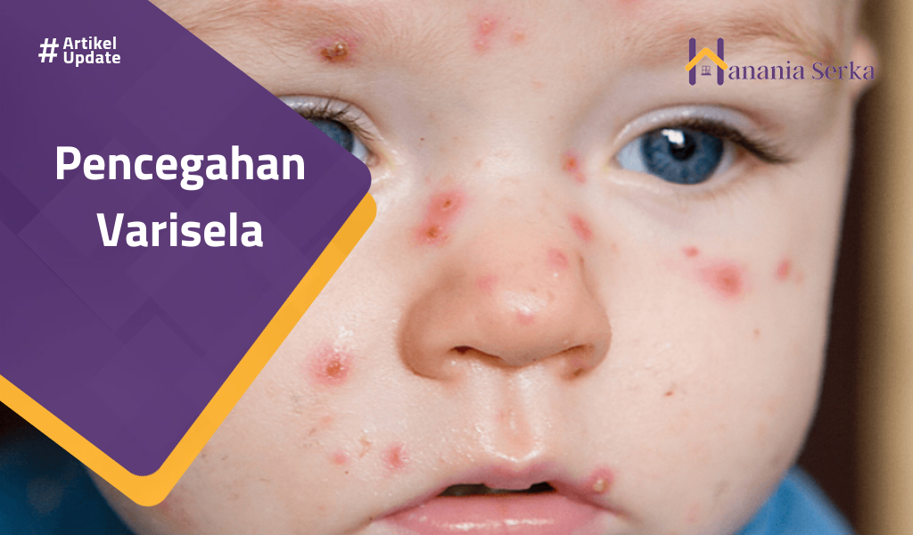 Read more about the article Pencegahan Varisela