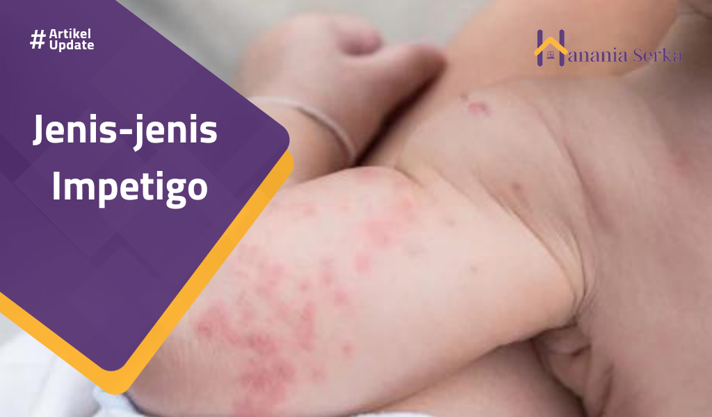 You are currently viewing Jenis-jenis Impetigo