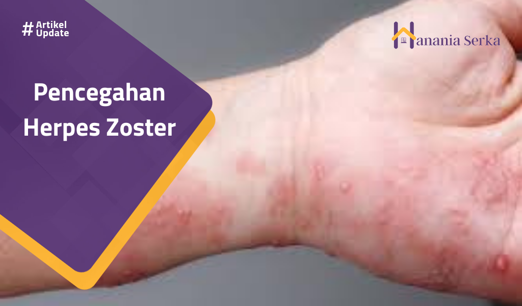 You are currently viewing Pencegahan Herpes Zoster