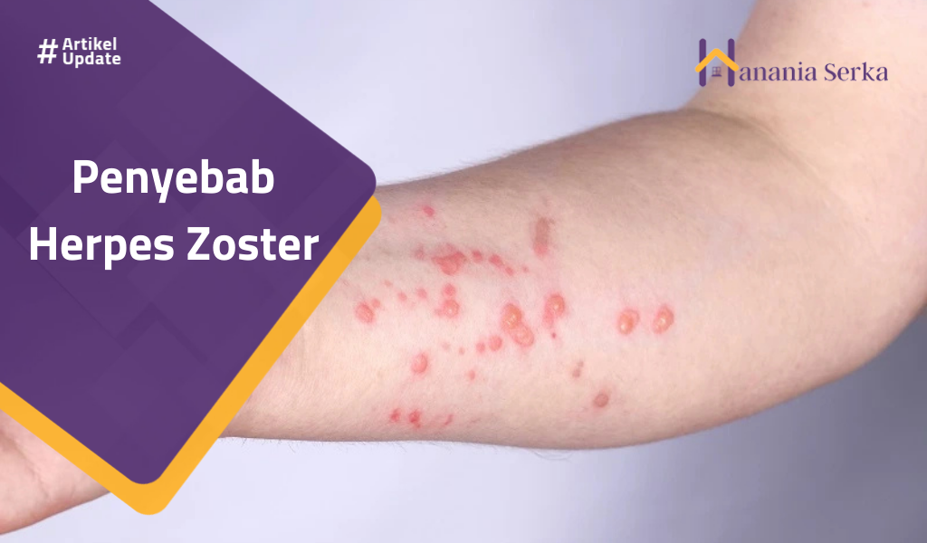 You are currently viewing Penyebab Herpes Zoster