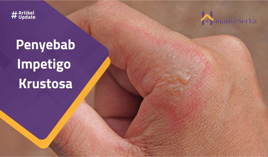 Read more about the article Pencegahan Impetigo Krustosa