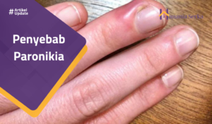 Read more about the article Penyebab Paronikia