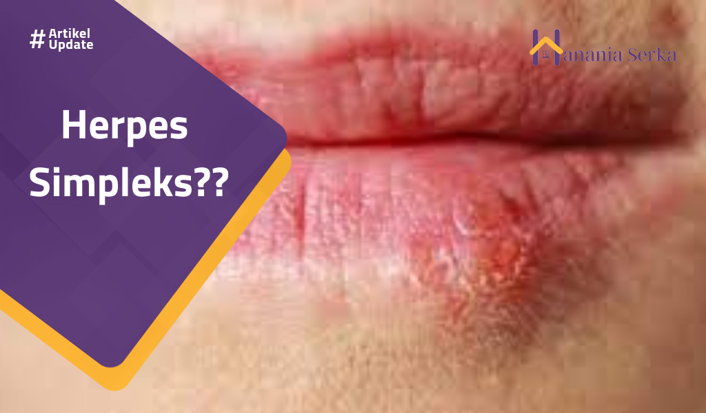 You are currently viewing Herpes  Simpleks??