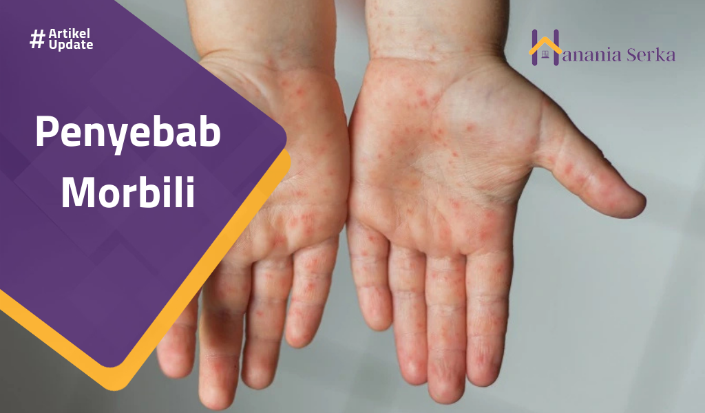 You are currently viewing Penyebab Morbili
