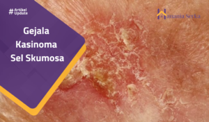 Read more about the article Gejala Karsinoma Sel Skuamosa