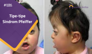 Read more about the article Tipe-tipe Sindrom Pfeiffer