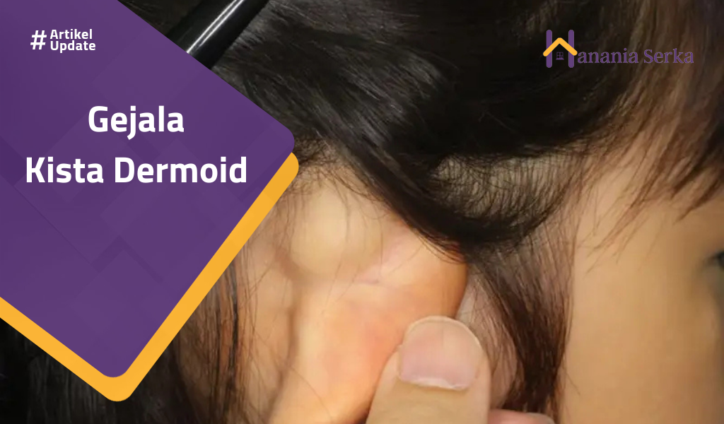 You are currently viewing Gejala Kista Dermoid